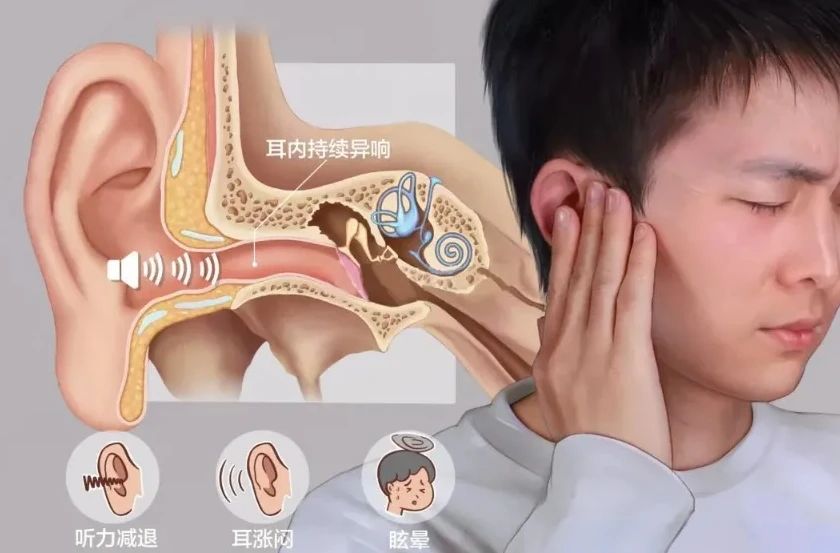 夏季气温升高更易耳鸣？